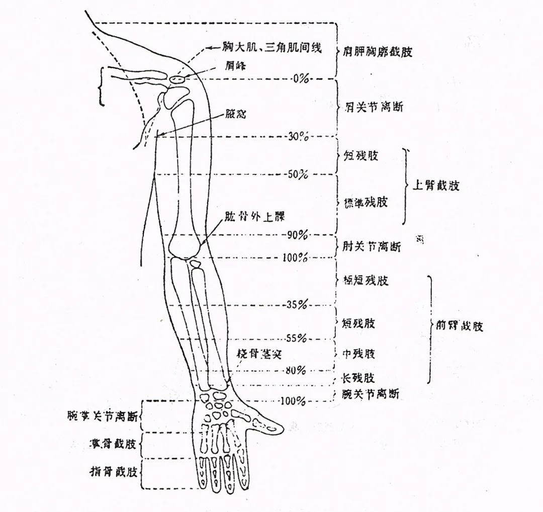 科普 | 上肢截肢部位名称及假肢装配方案(图1)