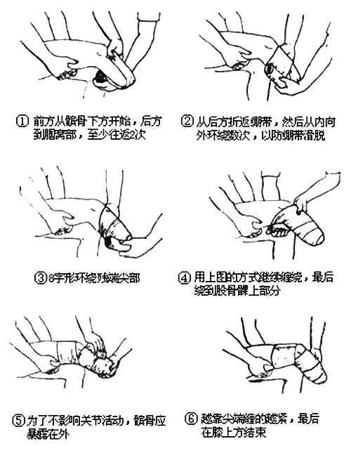 什么是残肢定型?如何促进残肢定型?(图2)