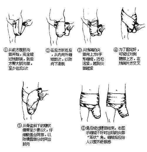 什么是残肢定型?如何促进残肢定型?(图3)