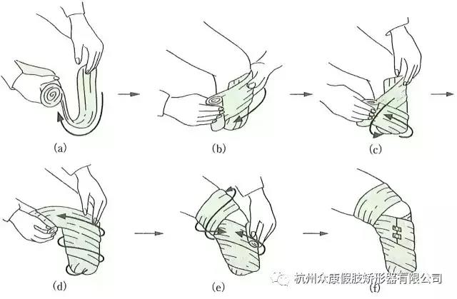 科普丨截肢后如何康复？划重点了！(图2)